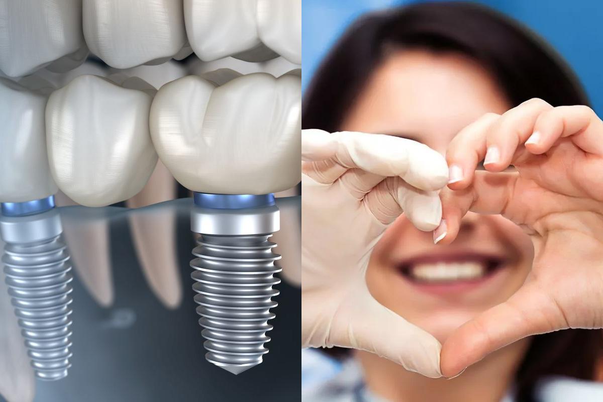 Referencias visuales para el diseño del logotipo de DentiBlue, con un implante dental y una odontóloga formando un corazón con las manos